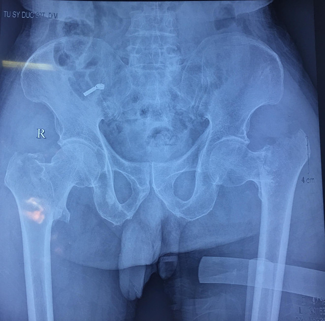 Hy hữu: Phẫu thuật thay khớp háng 2 bên cho cụ ông 92 tuổi ảnh 2