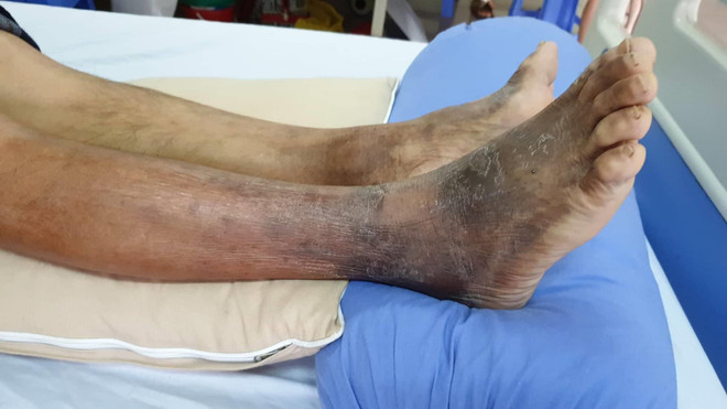 Tháo gỡ những nút thắt về thuốc cho các bệnh nhân Hemophilia ảnh 2