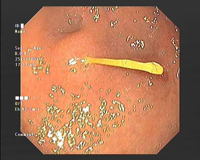 Sơ ý nuốt tăm vào bụng, một phụ nữ suýt thủng dạ dày ảnh 2