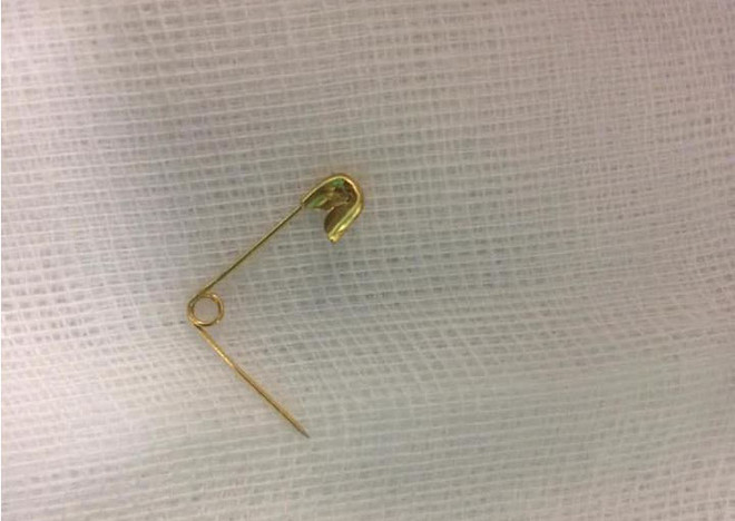 Nội soi và gắp thành công kim băng trong thực quản cho bé gái 4 tuổi ảnh 1