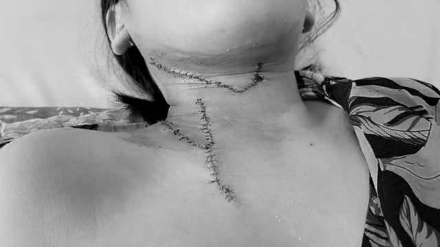 Bé gái 4 tuổi chui vào máy tời vải bị cán nghiến bàn tay phải ảnh 1