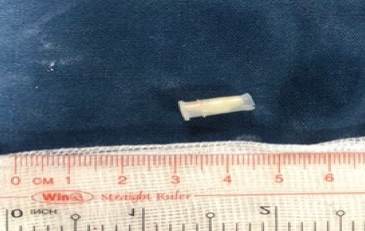 Nội soi gắp chiếc còi đồ chơi trong phế quản bé trai 3 tuổi ảnh 1