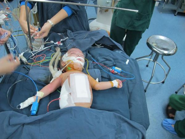 Phẫu thuật tách thành công hai trẻ 4 tháng tuổi dính liền bụng ảnh 2