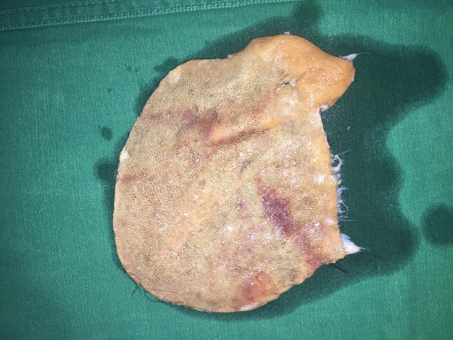 Nối vi phẫu cho một phụ nữ bị máy cuốn lột gần hết da đầu ảnh 1