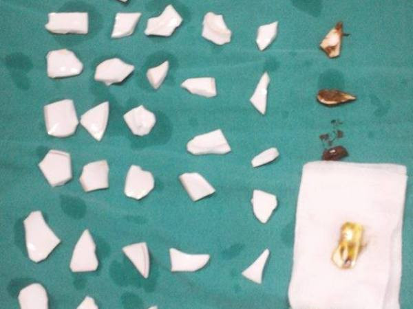 Phẫu thuật gắp 59 mảnh chén trong bụng một bệnh nhân ảnh 1