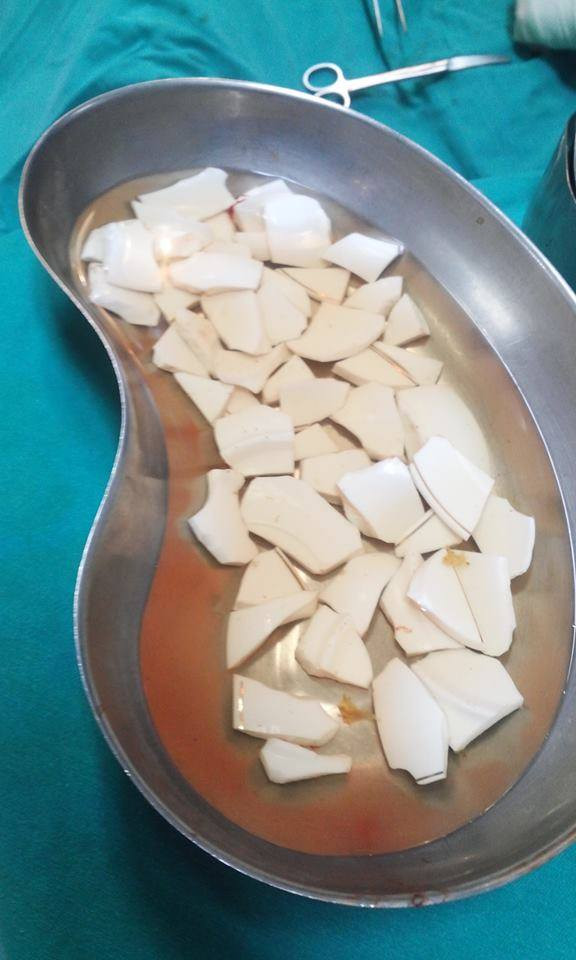 Phẫu thuật gắp 59 mảnh chén trong bụng một bệnh nhân ảnh 2