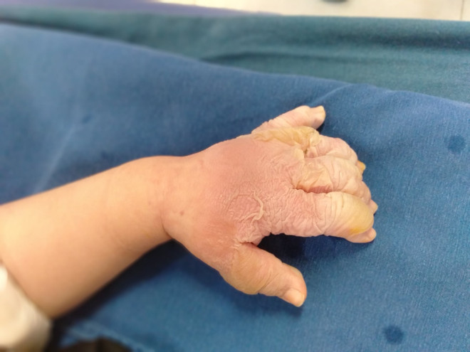 Cảnh báo trẻ nhỏ bị tai nạn bỏng nghiêm trọng và cách sơ cứu ban đầu ảnh 2