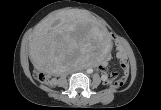 Phẫu thuật cho bệnh nhân mang khối u cổ tử cung nặng 7kg ảnh 1