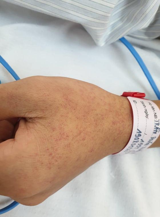 Dịch sốt xuất huyết tăng đột biến, đã có 50 trường hợp tử vong ảnh 2