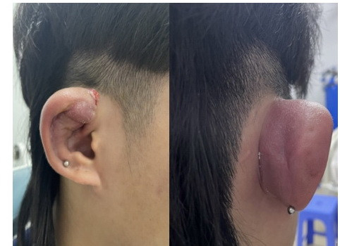 Bác sỹ cảnh báo hiểm họa khôn lường từ việc xỏ lỗ trên vành tai ảnh 1