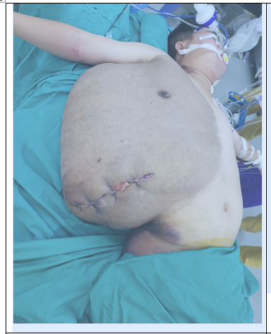 Phẫu thuật cắt bỏ thành công khối u vùng lưng nặng tới 23kg ảnh 2