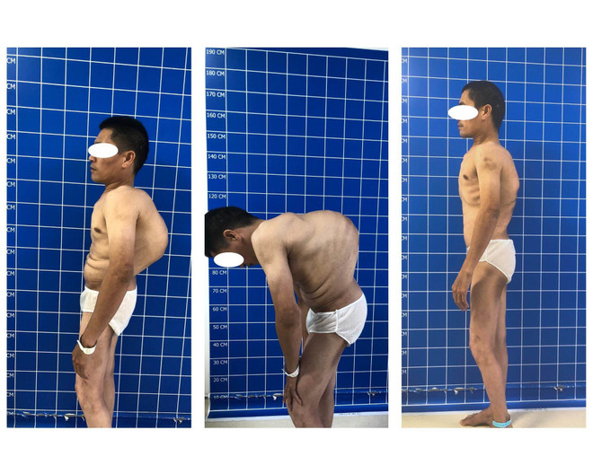Phẫu thuật lấy lại hình dạng cho bệnh nhân gù vẹo cột sống đặc biệt ảnh 2