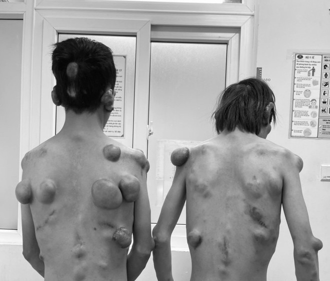Phẫu thuật cho 2 anh em sinh đôi có hàng trăm khối u trên cơ thể ảnh 1