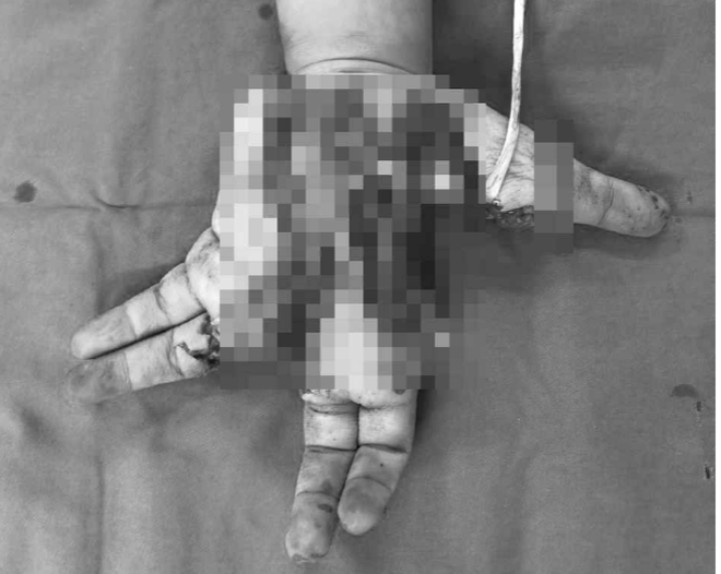 Một thiếu niên bị nát bàn tay trái do điện thoại nổ khi đang sử dụng ảnh 1