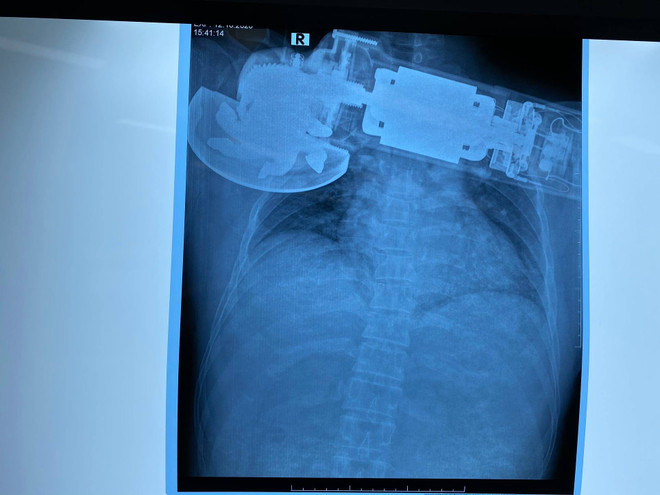 Cấp cứu một người đàn ông bị máy cắt găm sâu vào ngực phải ảnh 1