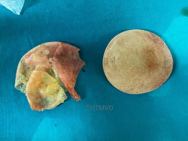 Bị bầm tím ngực trong thời gian dài vì không biết bị vỡ túi ngực ảnh 1