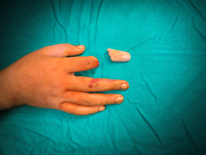 Nối thành công ngón tay bị đứt rời hoàn toàn cho bé trai 11 tuổi ảnh 2