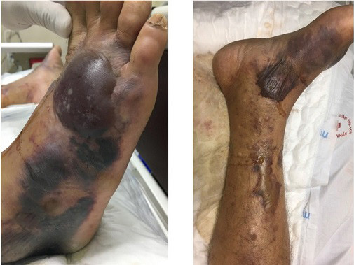 Cảnh giác với loài vi khuẩn “ăn thịt người” do ăn hải sản sống ảnh 1