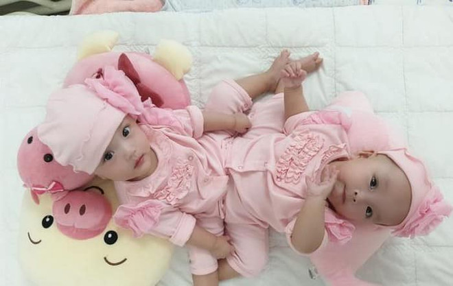 Gần 100 y bác sỹ sẽ tiến hành phẫu thuật tác đôi hai bé song sinh ảnh 1