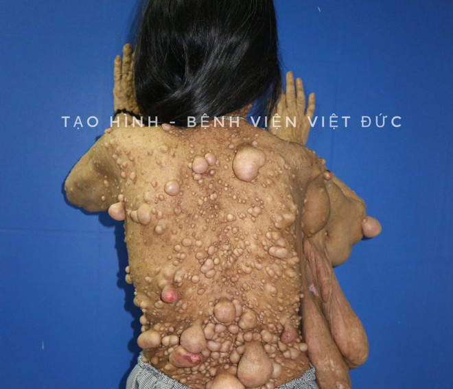 Phẫu thuật cắt bỏ “cánh đại bàng” khổng lồ cho một phụ nữ ảnh 1