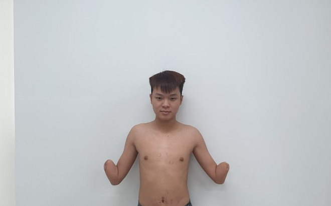 Ghép thành công 2 cẳng tay cho bệnh nhân: Kỳ tích mới của y học Việt ảnh 2