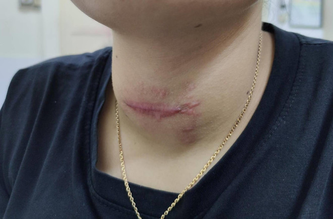 Cô gái loét vùng cổ nghiêm trọng do đắp thuốc lá chữa basedow ảnh 2