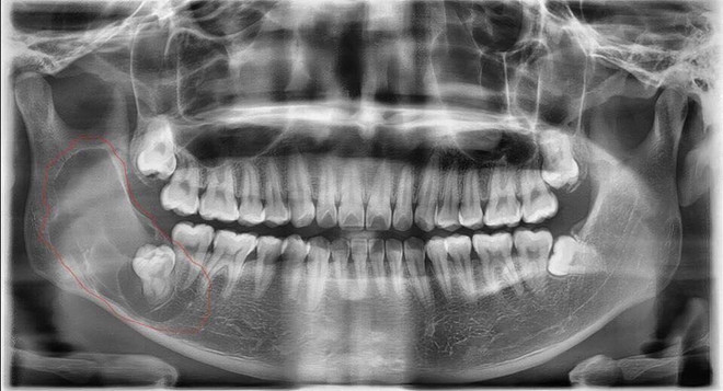 Nam thanh niên 26 tuổi có nang răng sừng hóa hiếm gặp ảnh 2