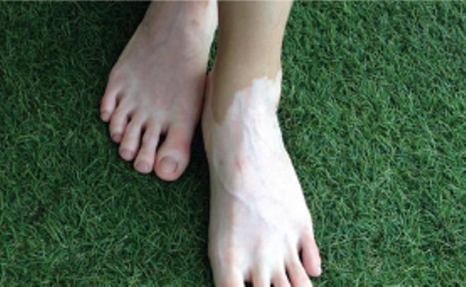 Bệnh viện da liễu Trung ương khám tư vấn miễn phí về bệnh bạch biến ảnh 1