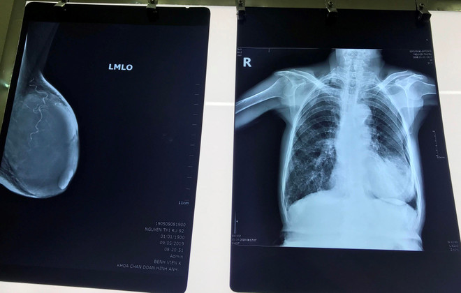 Phẫu thuật thành công điều trị ung thư vú cho cụ bà 92 tuổi ảnh 1