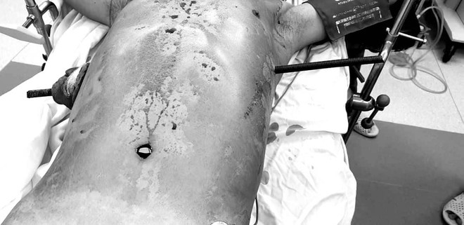 Cứu sống bệnh nhân bị thanh sắt đâm xuyên ngang qua người ảnh 2