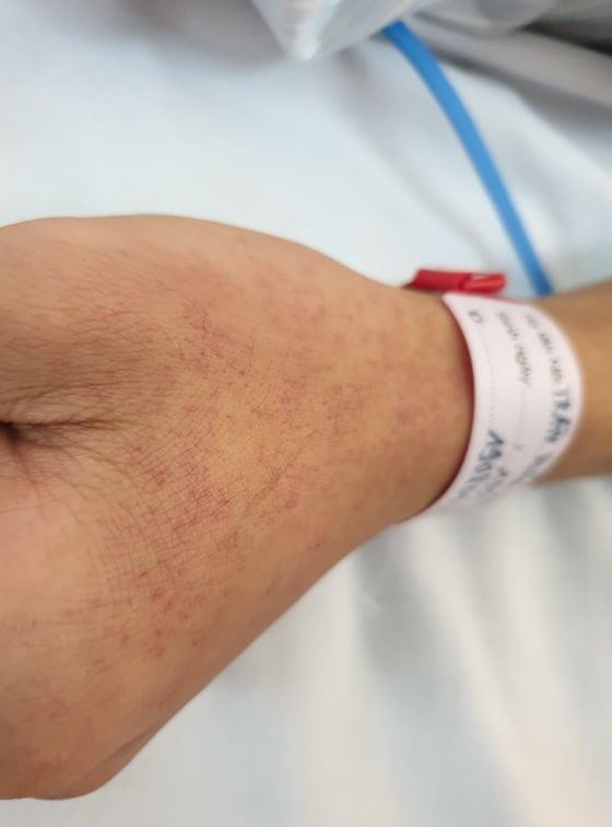 Bệnh nhân mắc bệnh sốt xuất huyết với những nốt phát ban nổi trên da. (Ảnh: T.G/Vietnam+) Nguy cơ bùng phát dịch bệnh sốt xuất huyết trong cả nước ảnh 3
