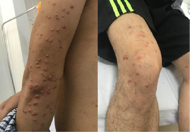 Một thanh niên bị u vàng phát ban từ triệu chứng nổi nốt ngoài da ảnh 1
