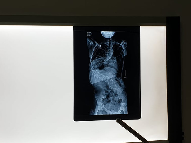 Hà Nội: Nữ bệnh nhân 13 tuổi cột sống uốn lượn như chữ S ảnh 1