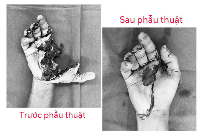 Bàn tay bị dập nát của bệnh nhân do pháo nổ gây ra. (Ảnh: PV/Vietnam+) ảnh so 2.jpeg