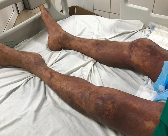 Hà Nội ghi nhận 2 trường hợp tử vong vì mắc liên cầu lợn ảnh 1