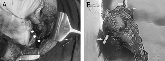 Một bệnh nhân bị thủng tử cung do đặt dụng cụ tránh thai 30 năm ảnh 2