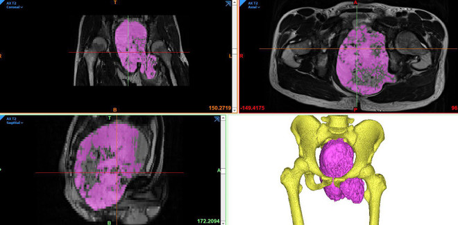 Đại phẫu cho ca mắc ung thư xương với khối u trên 20cm hiếm gặp ảnh 2