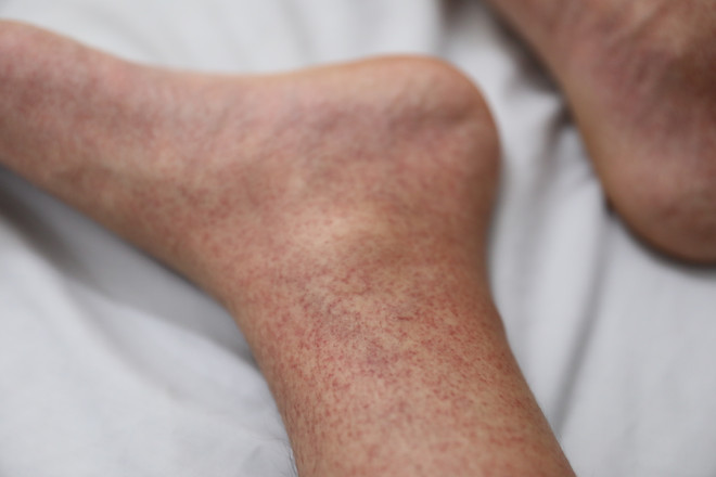 Cả nước ghi nhận 5.616 trường hợp mắc sốt xuất huyết trong một tuần ảnh 2