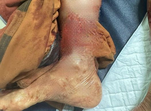 Bị chó nuôi của nhà cắn, bệnh nhân cấp cứu trong tình trạng nguy kịch ảnh 1