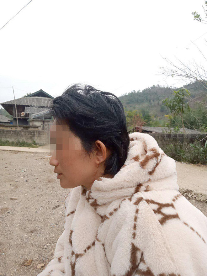 Nối thành công da đầu cho bệnh nhân bị lột da rộng và phức tạp ảnh 3