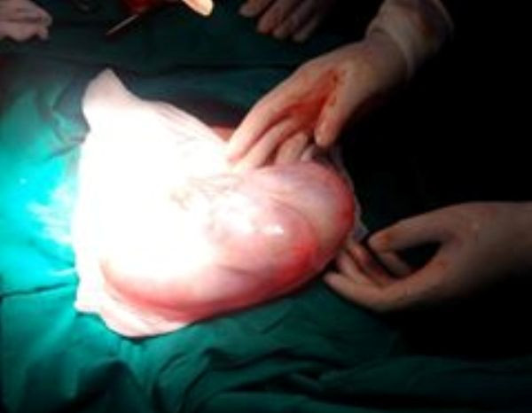 Phẫu thuật thành công một khối u buồng trứng có kích thước hơn 20cm ảnh 1