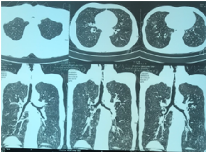 Cứu sống một bệnh nhân bị suy hô hấp cấp do hẹp khí quản ảnh 1