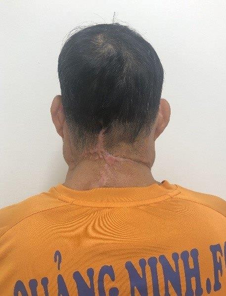 Bệnh nhân sau phẫu thuật. (Ảnh: PV/Vietnam+) Phẫu thuật thành công những khối u khổng lồ cho “người gấu” ảnh 2