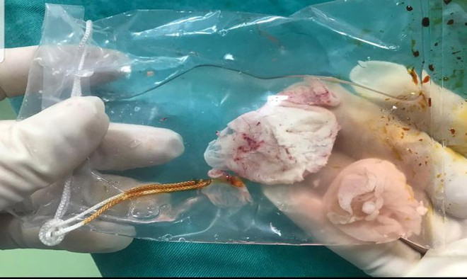 Đau đầu thường xuyên, đi khám phát hiện ổ sán lớn trong não ảnh 1