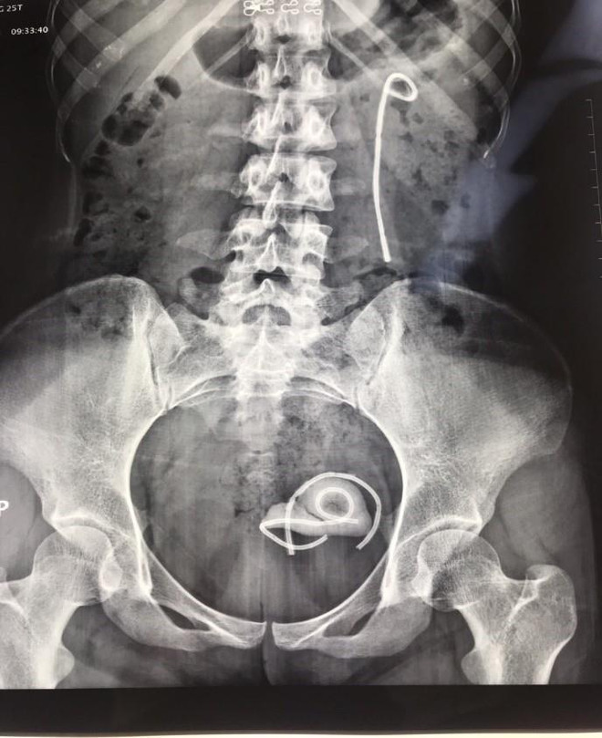 Bệnh nhân bị bỏ quên ống thông niệu quản suốt 5 năm ảnh 2