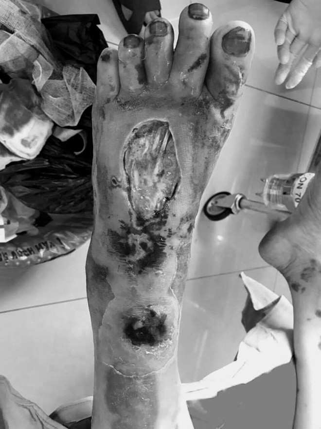 Chàng trai 28 tuổi bị cắt cụt chi do tự ý điều trị vết xước ở chân ảnh 1