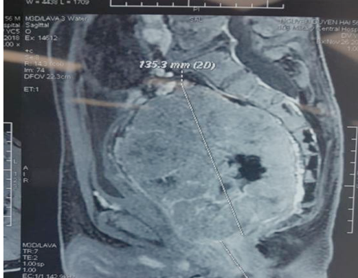 Phẫu thuật cắt bỏ thành công khối u trực tràng kích thước lớn ảnh 1