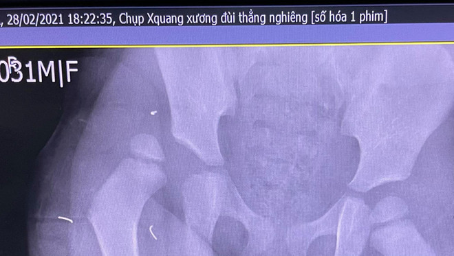 Hà Nội: Bé gái rơi từ tầng 12A chung cư bị trật khớp háng bên phải ảnh 1