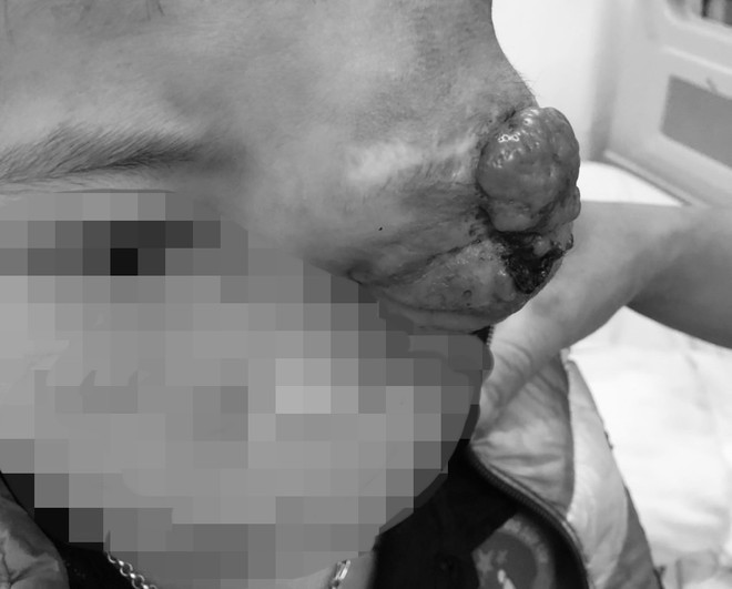 Phẫu thuật thành công u hốc mắt phức tạp cho cậu bé người dân tộc Thái ảnh 2