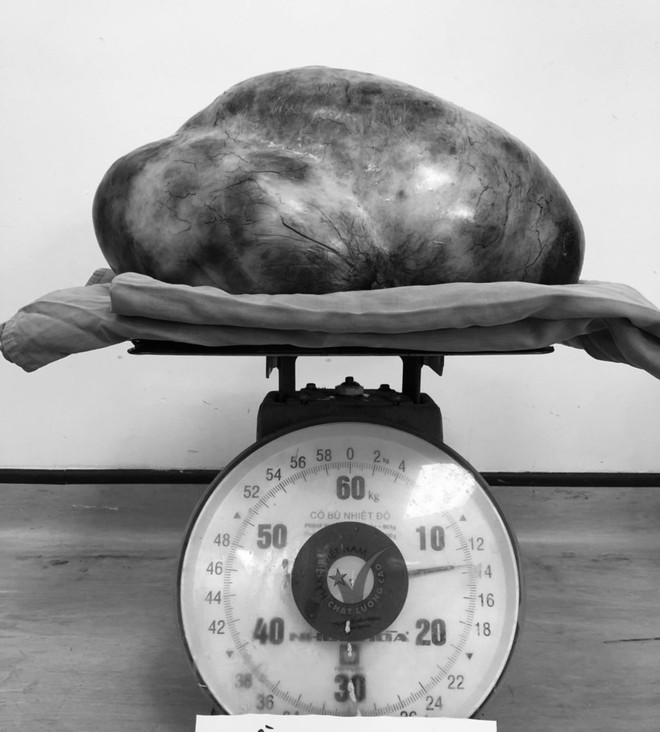 Người phụ nữ mang khối u buồng trứng “siêu khổng lồ” nặng 13kg ảnh 1